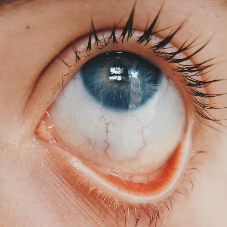 Dry Eye Syndrome: Causes, Symptoms & Effective Treatments